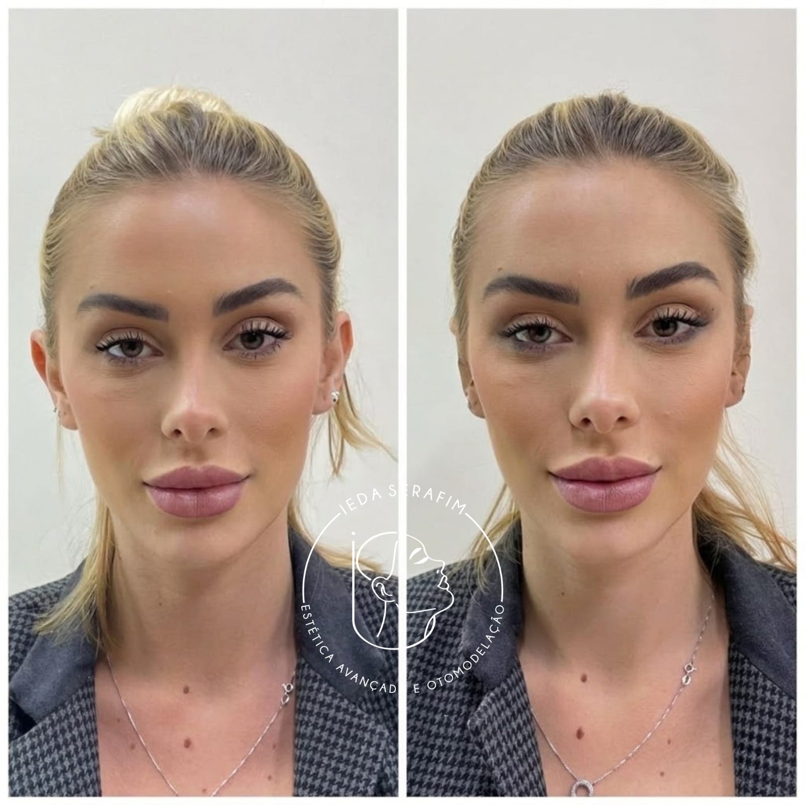 Antes e depois de uma otomodelação realizada pela Dra Ieda Serafim